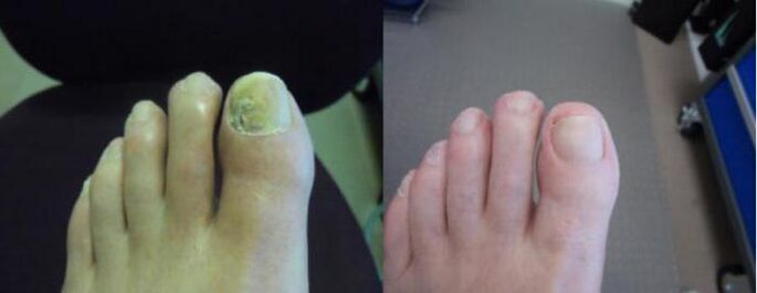 Fotos dos pés antes e despois de usar a crema Zenidol