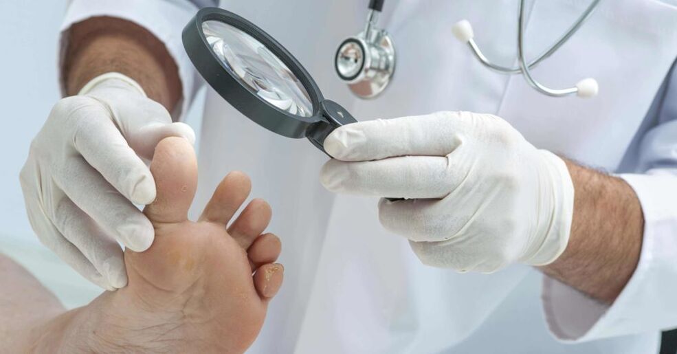 médico examina os pés con fungo