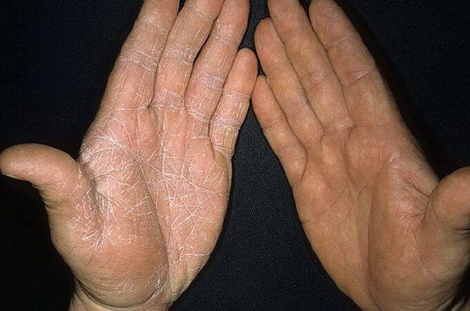 Síntomas dunha fungo na pel das mans