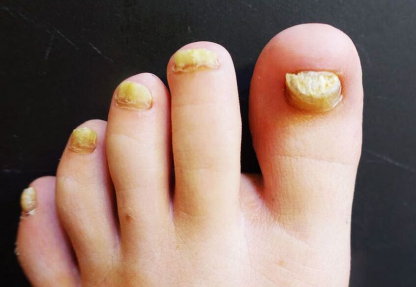 Aspecto antiestético das unhas dos pés afectadas por fungos