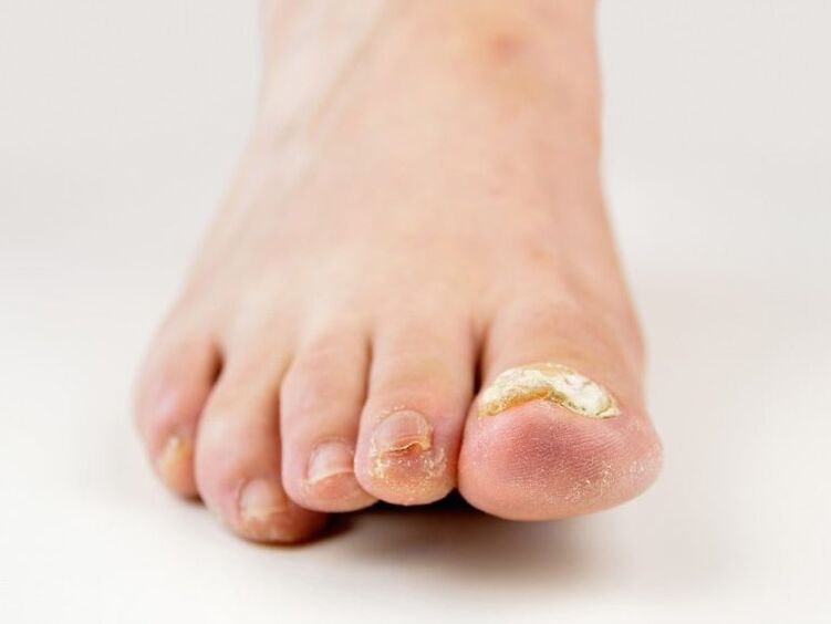 Unhas dos pés afectadas por fungos