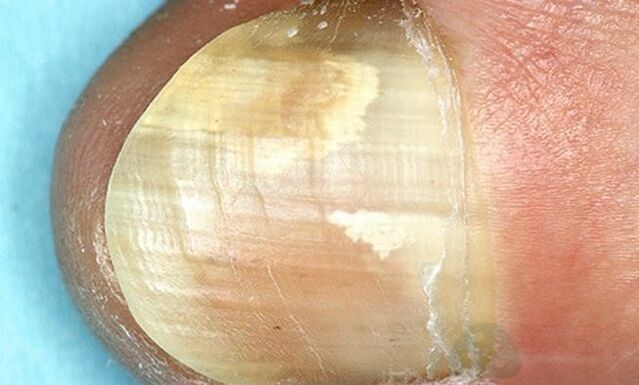 Tratamento do fungo das unhas coas preparacións internas