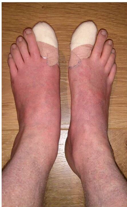 Eliminación das uñas dos pés afectadas por fungos