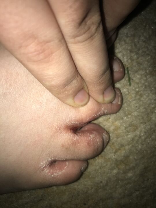 Infección por fungos nos dedos dos pés