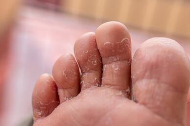 Síntomas das infeccións fúngicas dos dedos dos pés