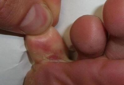 unha fisura no dedo do pé é o resultado dunha infección por fungos